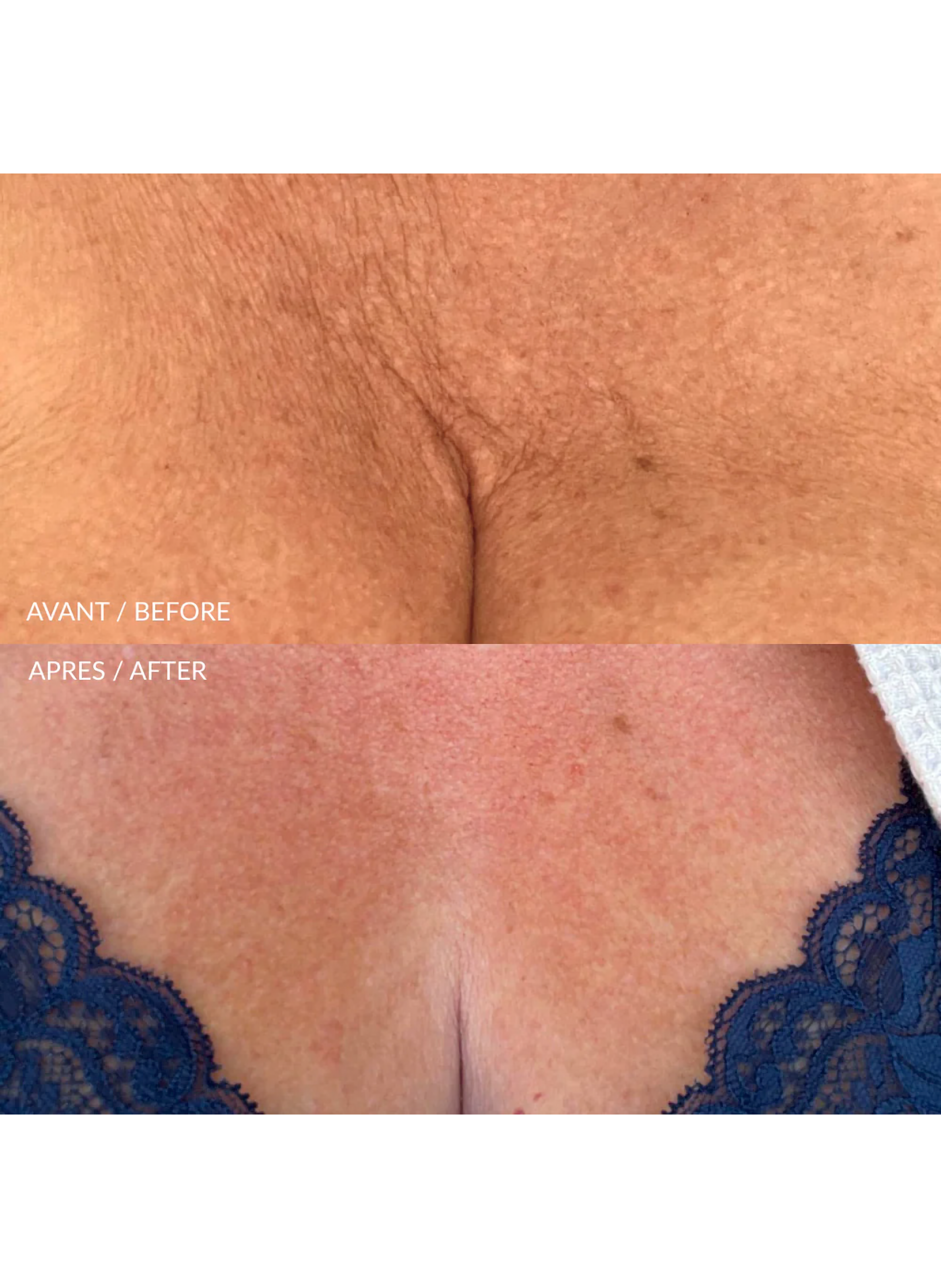 HydraLiss Patch Silicone Cou & Décolleté ROLL ON JADE No color