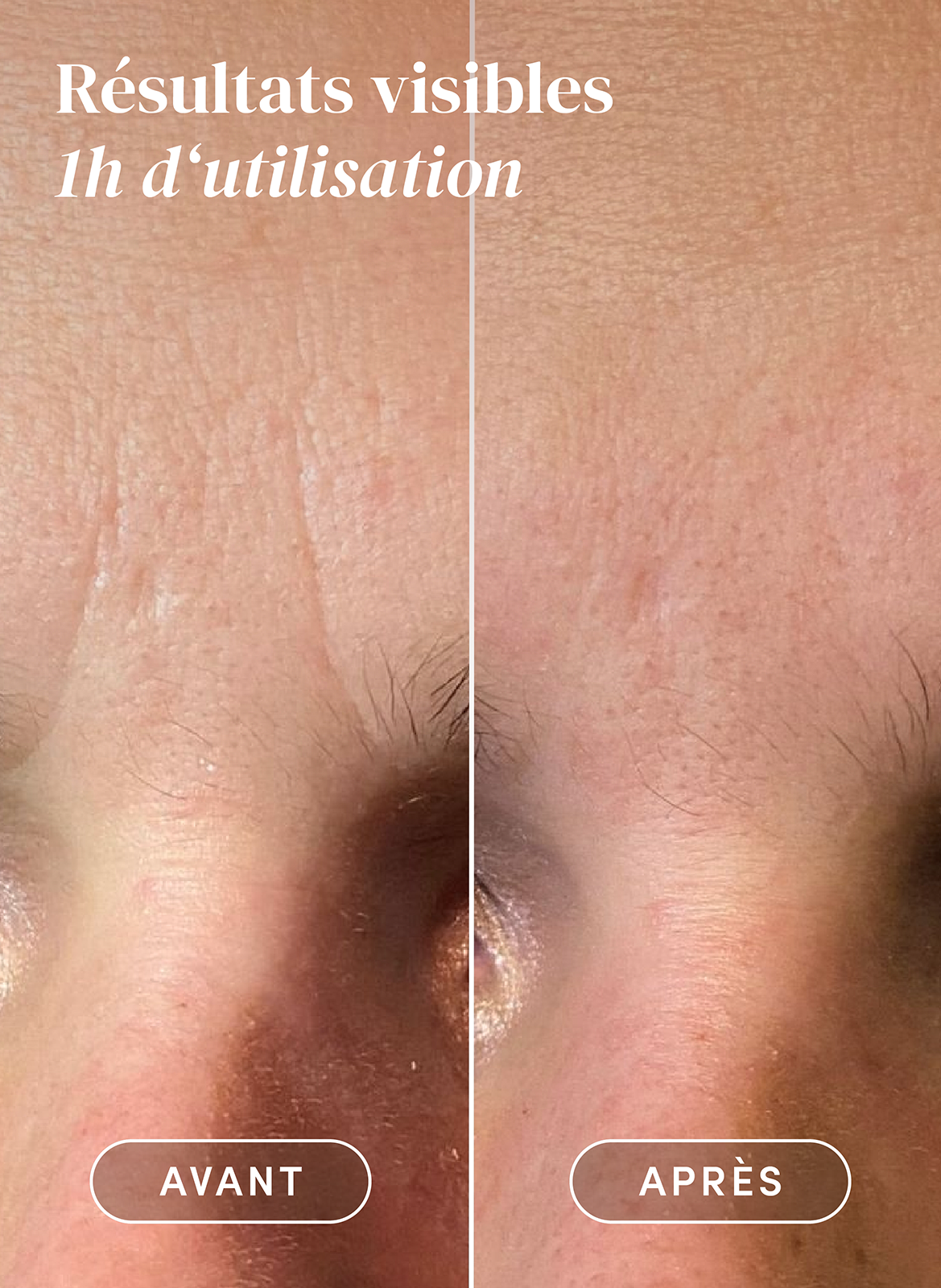 Patchs visage à la niacinamide APRICOT No color