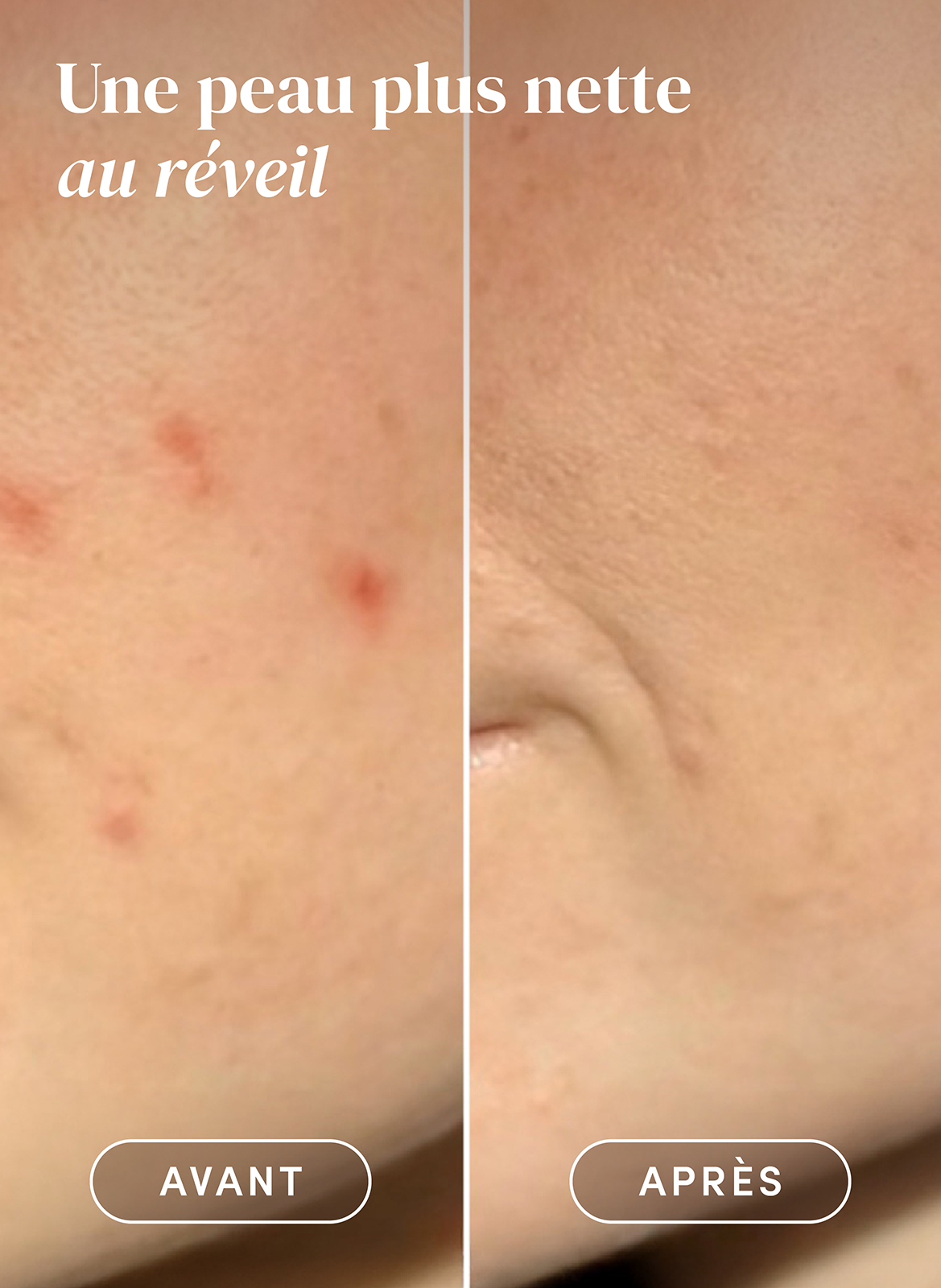 Patchs anti-boutons APRICOT No color