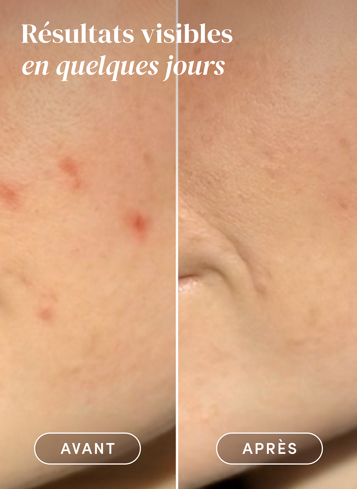 Patchs post-boutons APRICOT No color