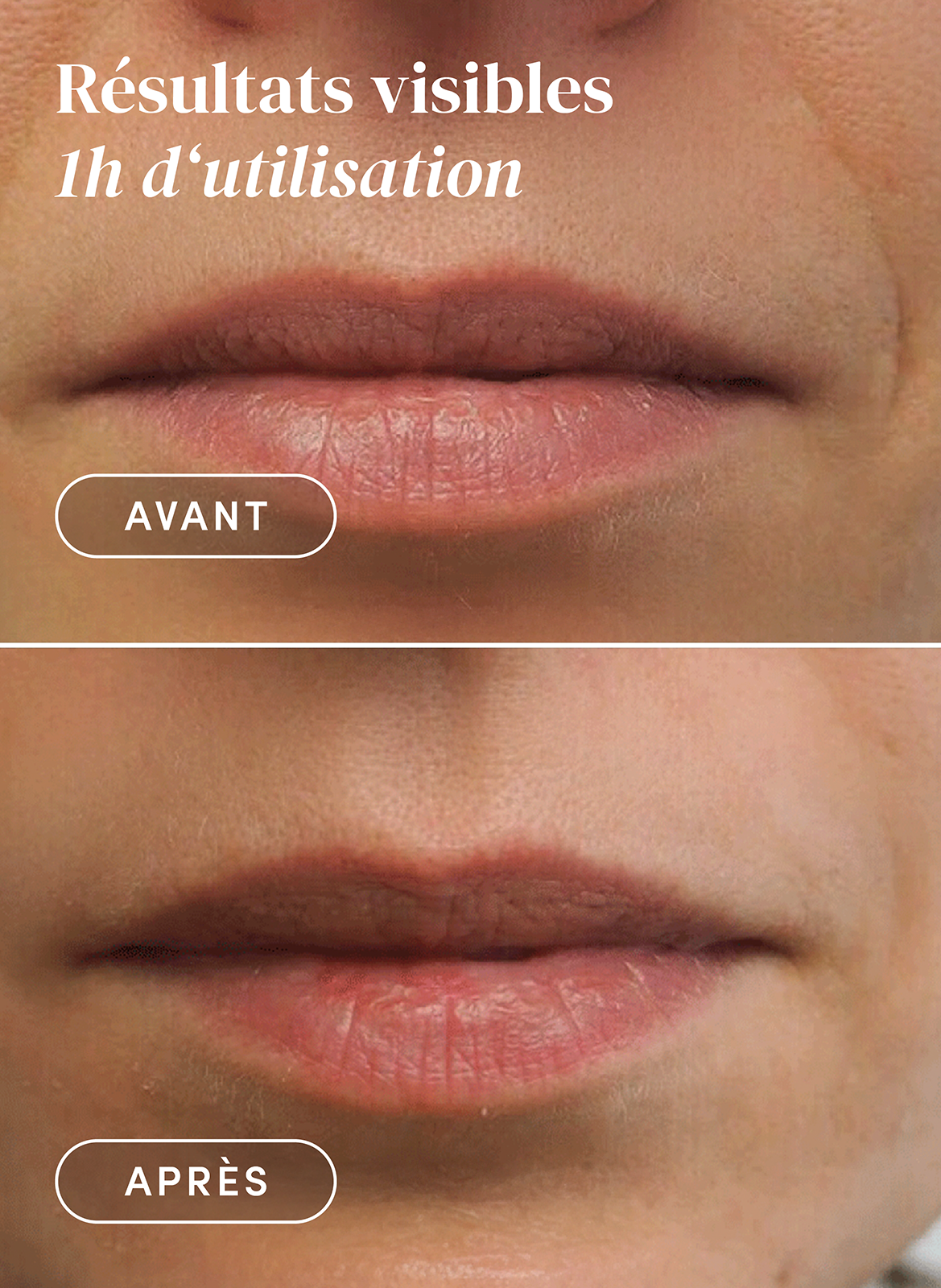 Patchs bouche à l’acide hyaluronique APRICOT No color