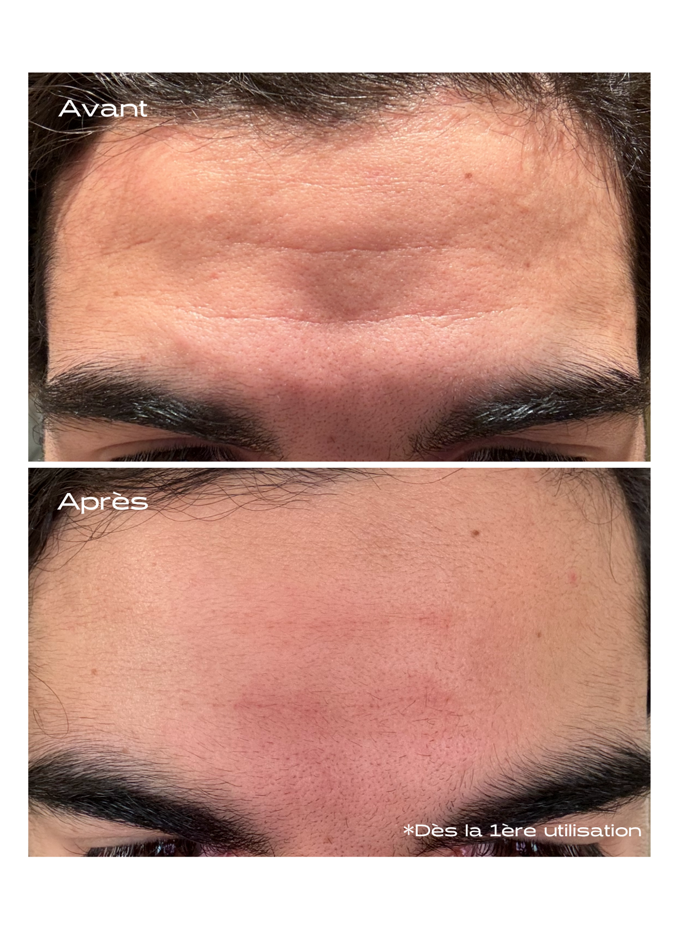 Patch Anti-Âge Microneedling KOSMOPELLIS No color