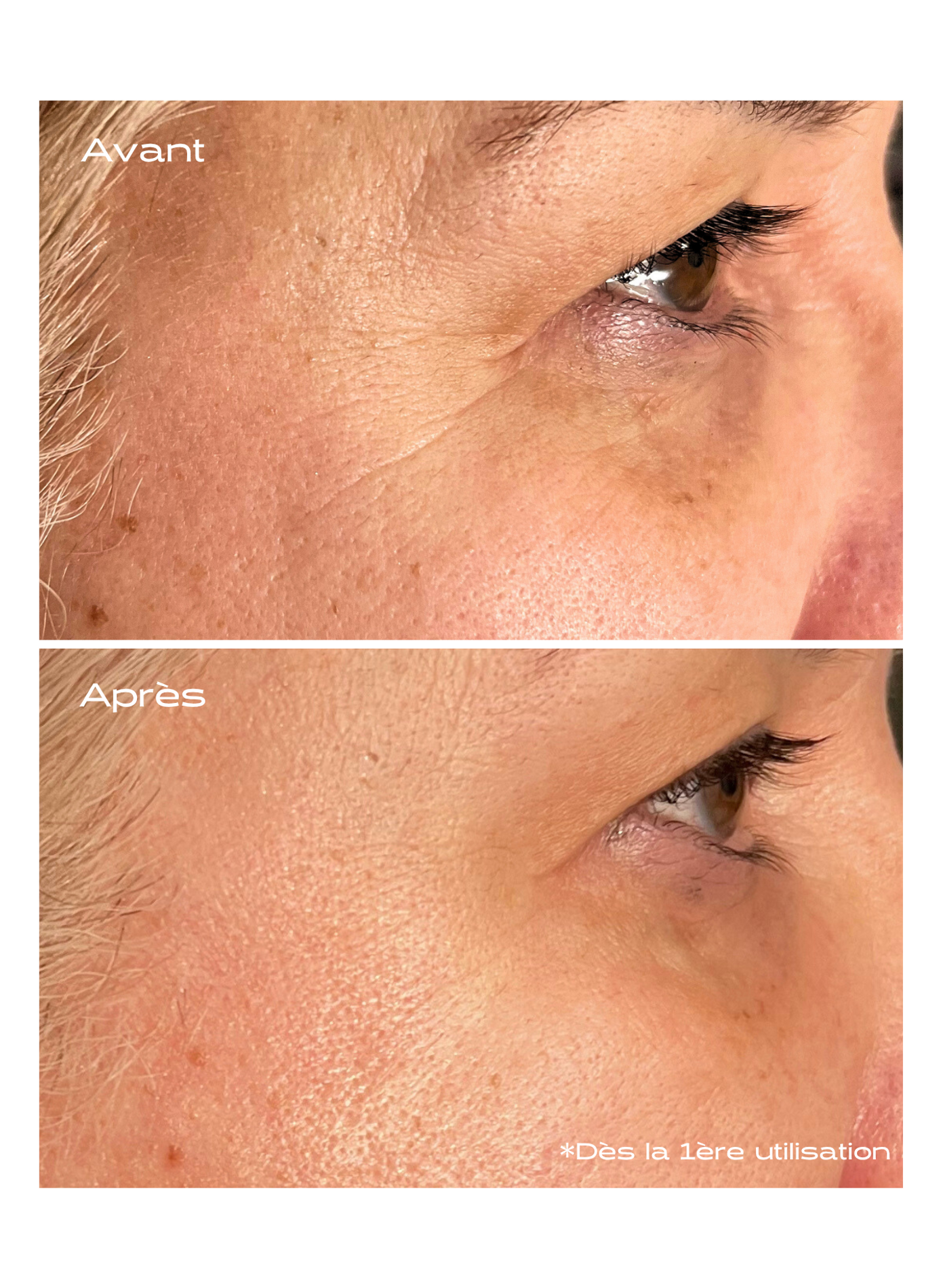 Patch Anti-Âge Microneedling KOSMOPELLIS No color