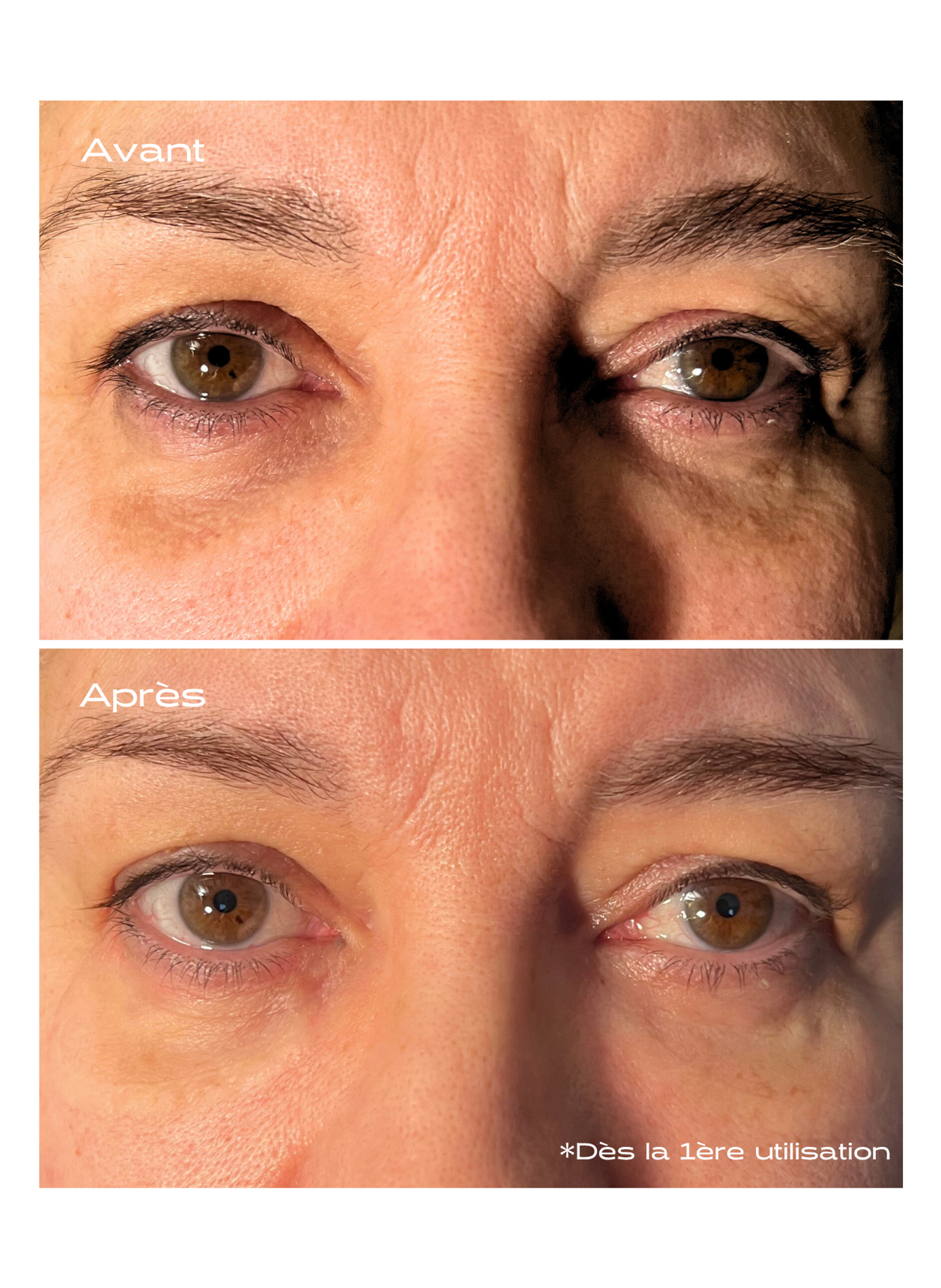 Patch Contour des Yeux Microneedling KOSMOPELLIS No color