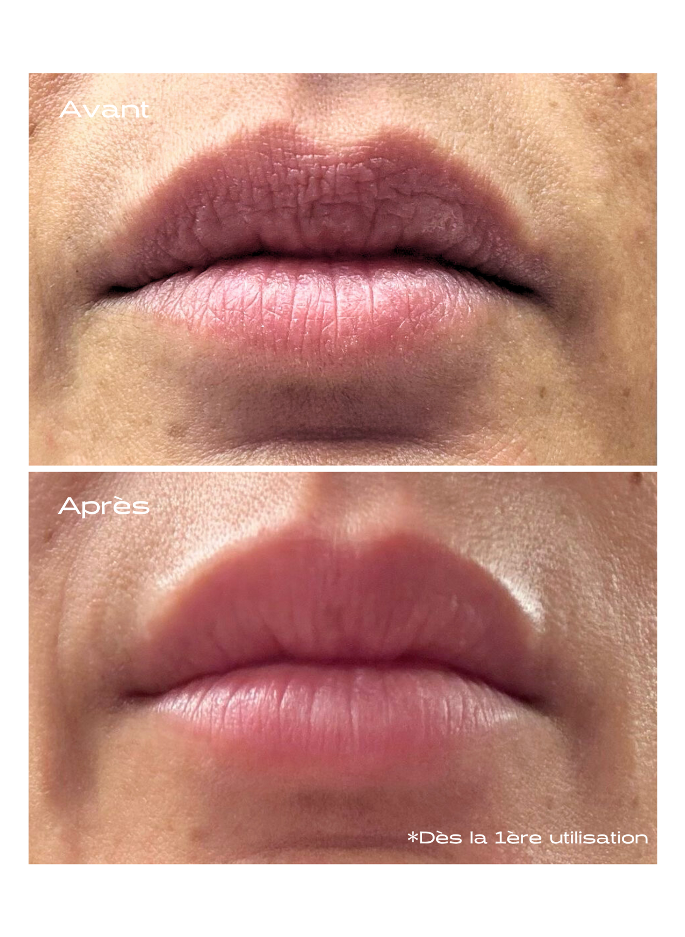 Patch Lèvres Microneedling KOSMOPELLIS No color