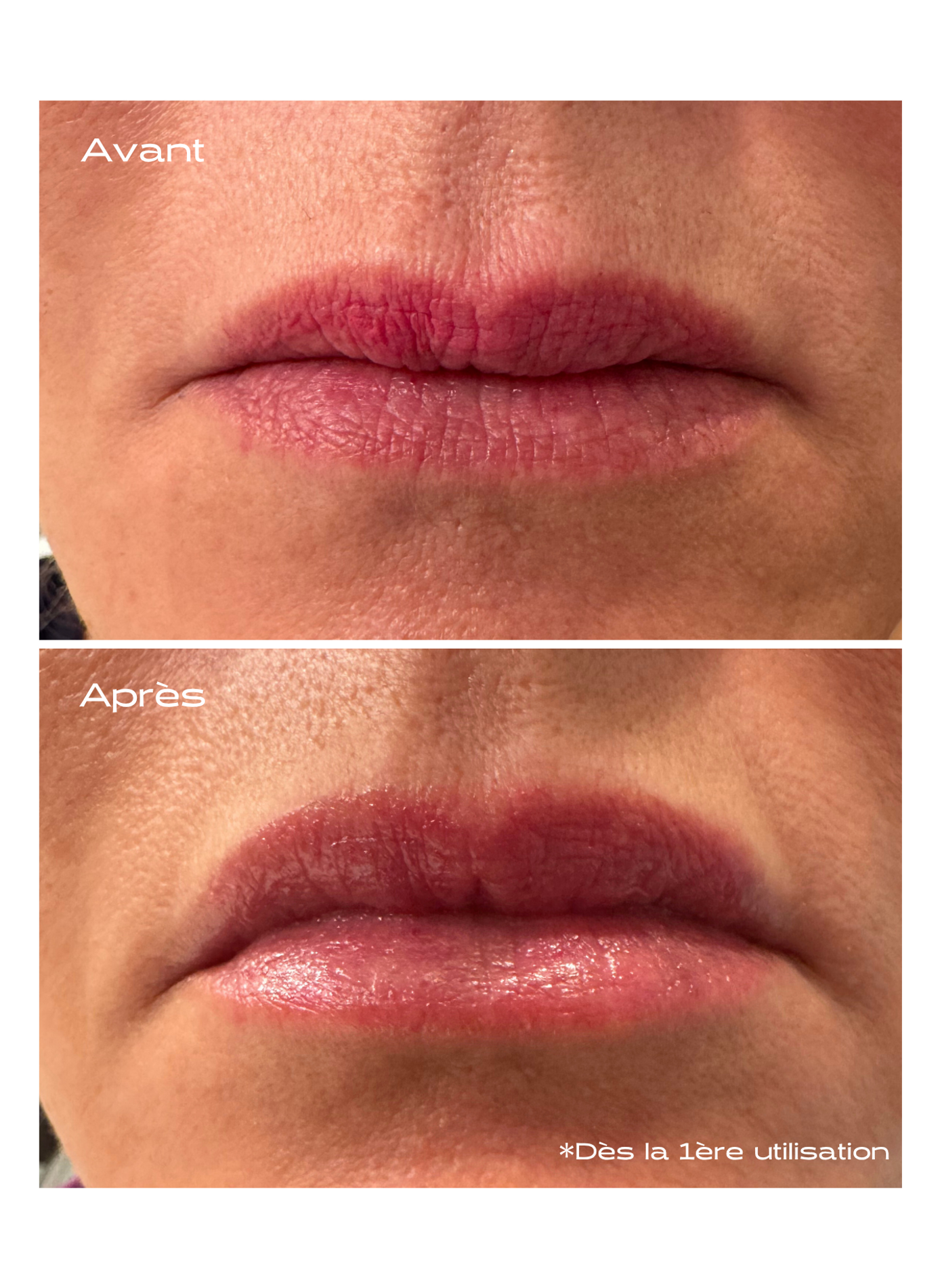 Patch Lèvres Microneedling KOSMOPELLIS No color