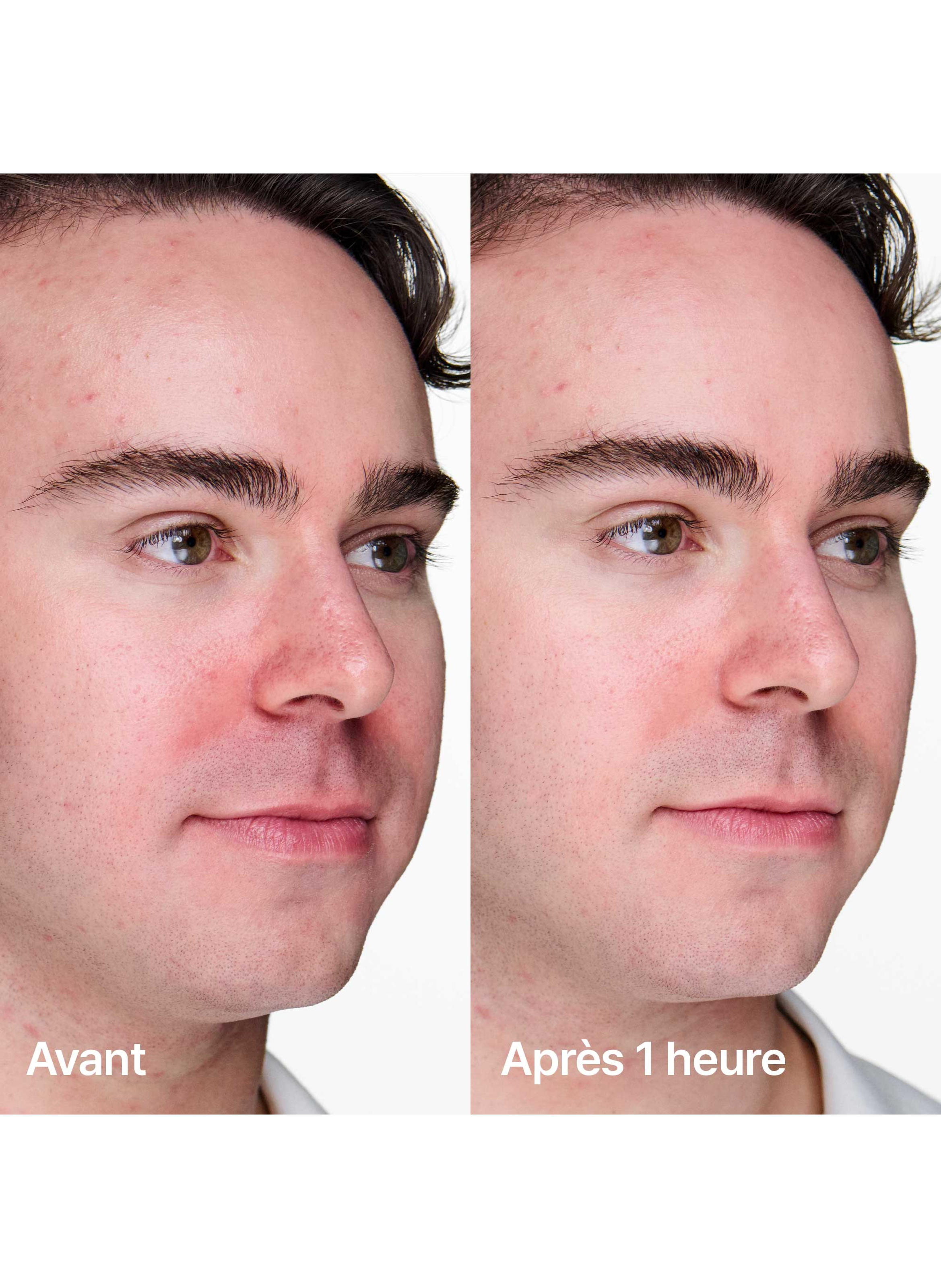 Anti-Blemish Solutions™ - Gel Anti-imperfections + CLINIQUE No color