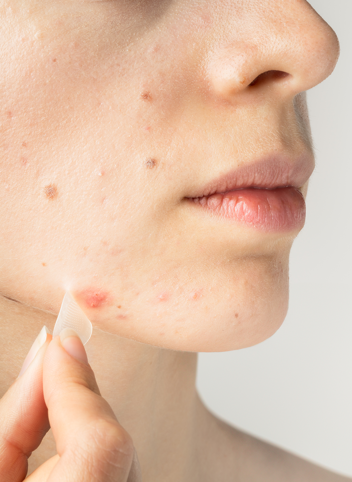 Clear out - Patchs micro-aiguilles SKIN &amp; OUT No color