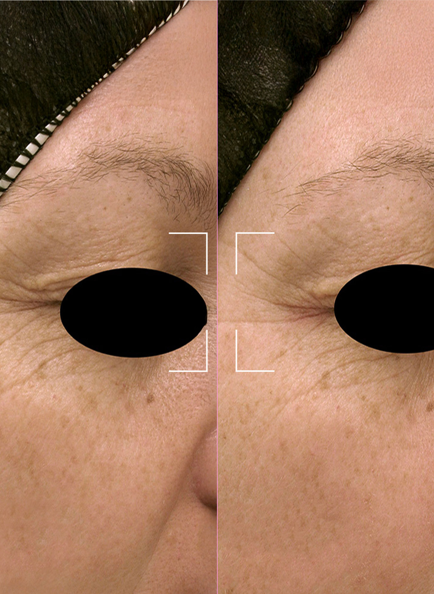 Capsules REPAIR – Sérum Réparateur Anti-Âge à Lumière LED LIGHTINDERM No color