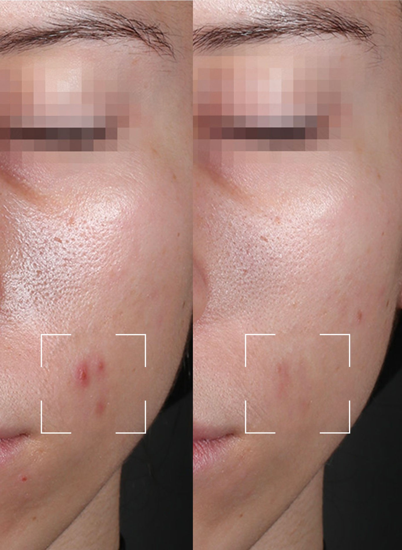 Capsules PURITY – Sérum Purifiant Matifiant à lumière LED LIGHTINDERM No color