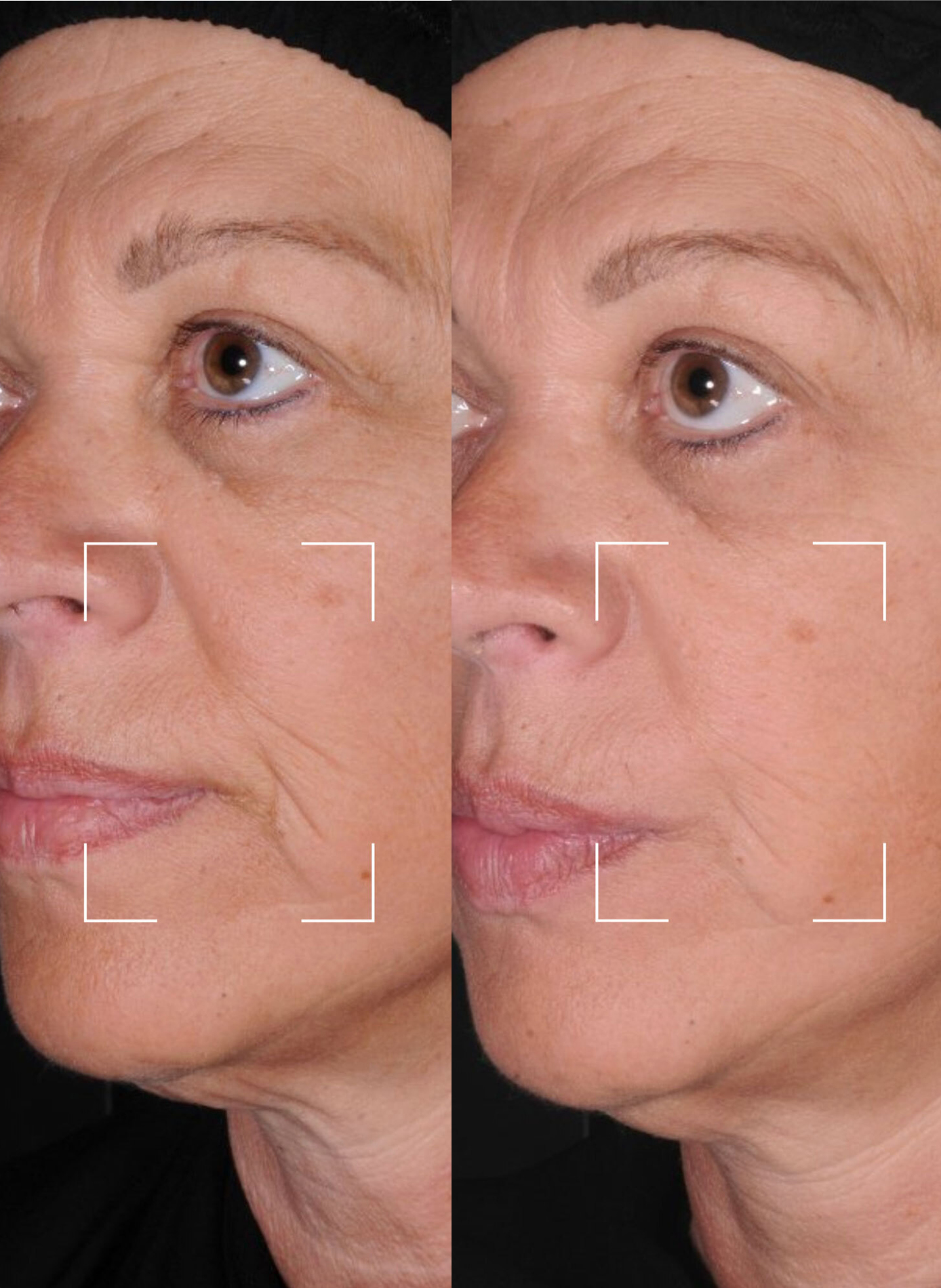 Capsules LIFT – Sérum Liftant Anti-Âge à Lumière LED LIGHTINDERM No color