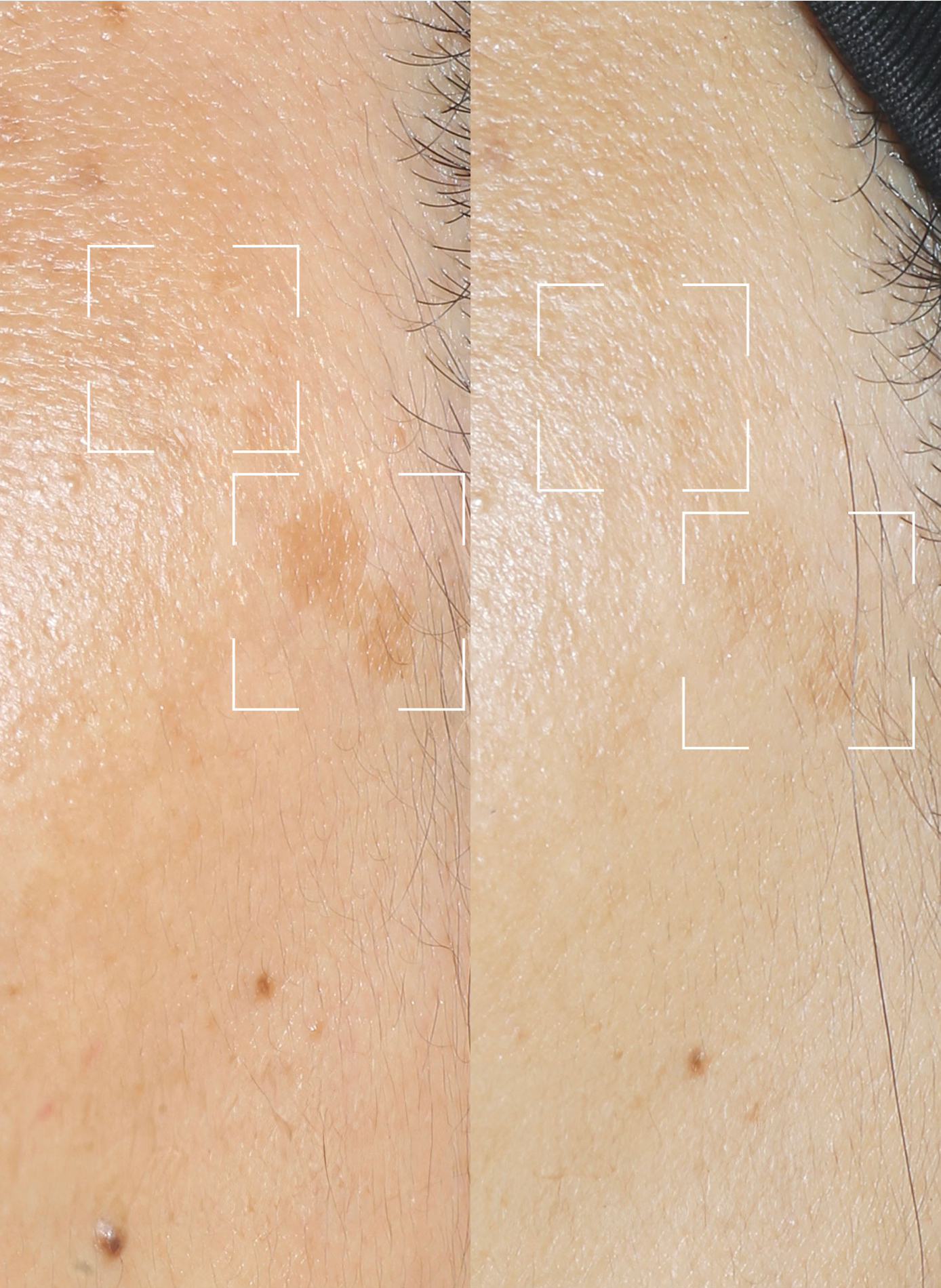 Capsules SPOTLESS – Sérum Correcteur Anti-Taches à lumière LED LIGHTINDERM No color